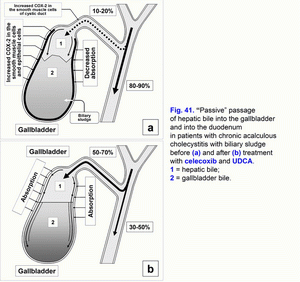 Passive passage of hepatic bile, chronic acalculus cholecystitis, biliary sludge